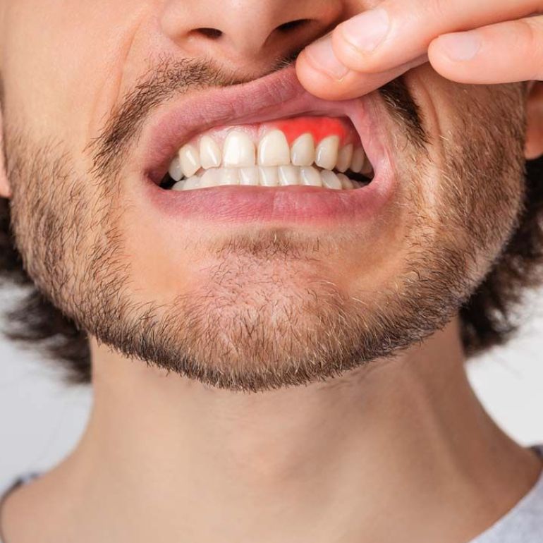 Bleeding Gum Treatment