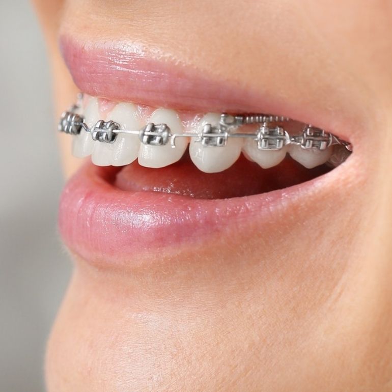 Braces Treatment