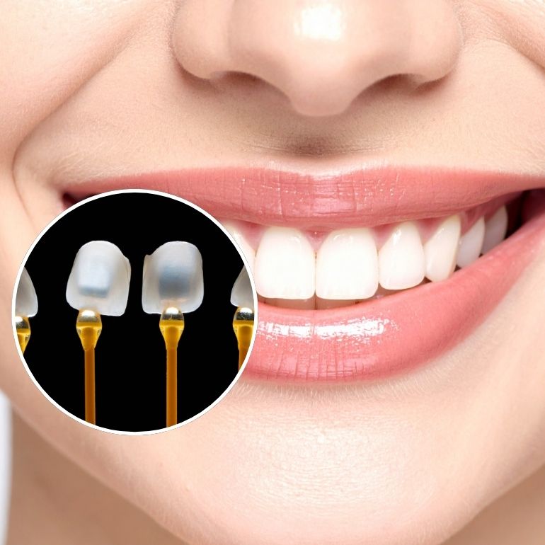 Dental Veneers