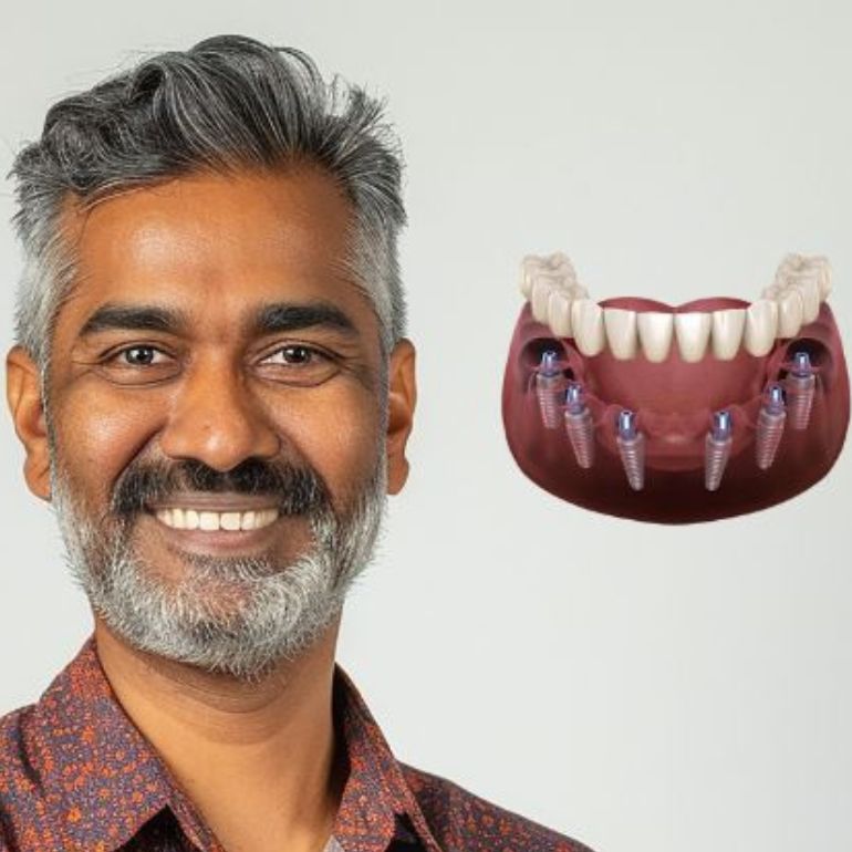 Full Mouth Rehabilitation 