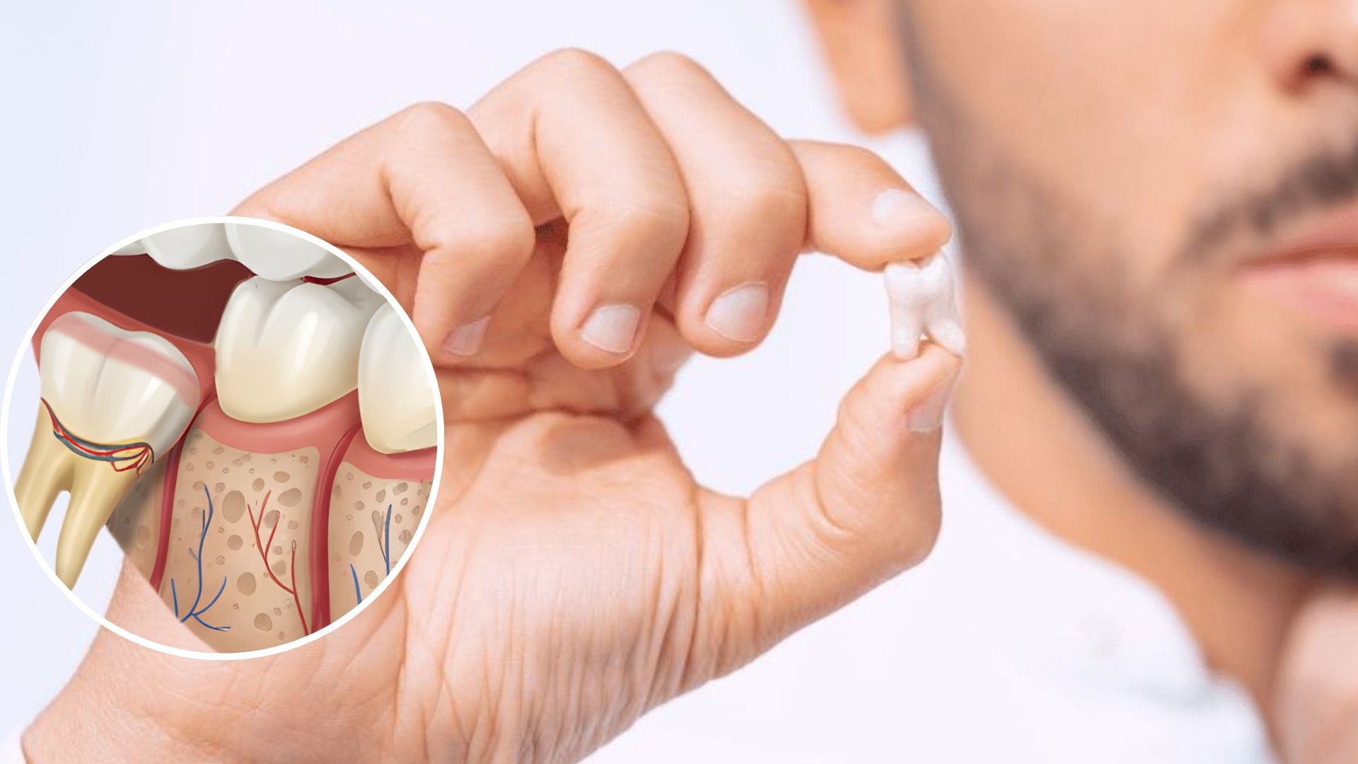 Wisdom Tooth Removal