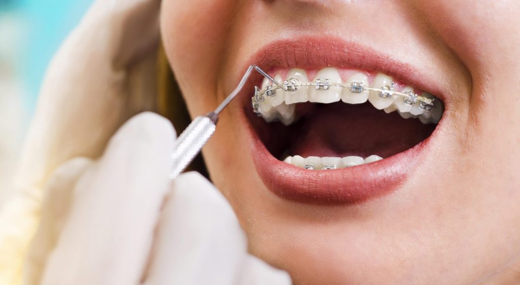 Braces Treatment in Pune Camp Braces Treatment Cost in Pune Camp